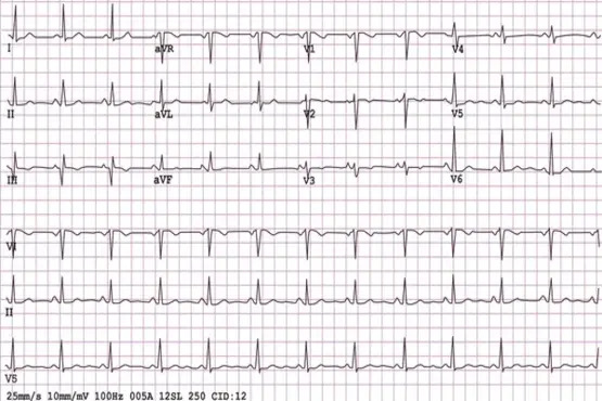 Exame de eletrocardiograma.