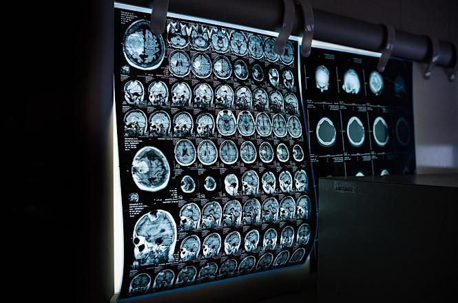 Foto colorida: exames de ressonância magnética em painel iluminado, ambiente clínico, diagnóstico médico, analisando imagens em preto, azul e branco