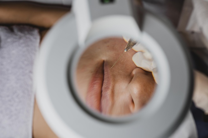 Procedimento estético facial é realizado com aplicação de agulha na região dos lábios, em imagem ampliada.